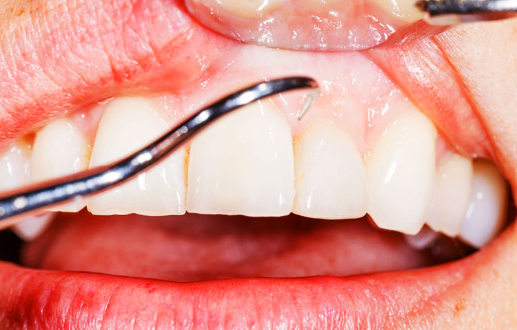 Diferencias entre periodontitis y gingivitis