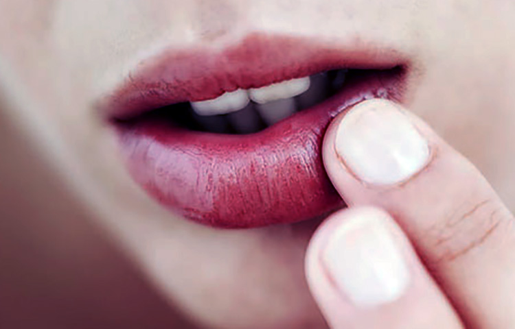 Como prevenir el herpes labial