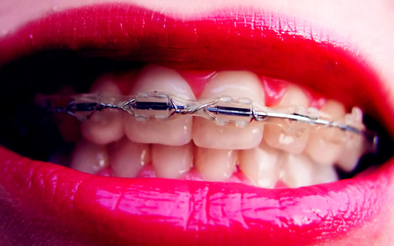 Diferencias entre los brackets cerámicos y los brackets metálicos