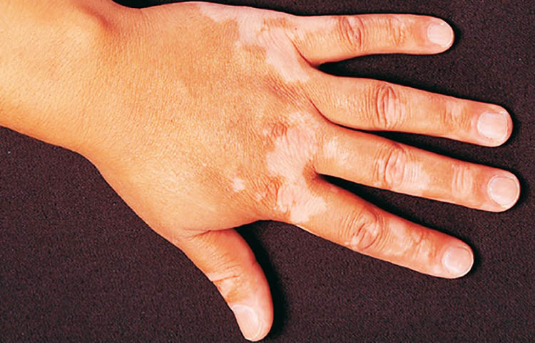 Posibles causas del vitiligo