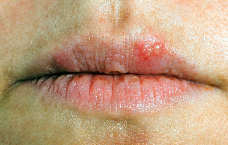 Que son los herpes labiales