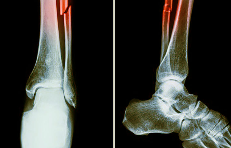 Cuáles son los signos y síntomas de las fracturas óseas