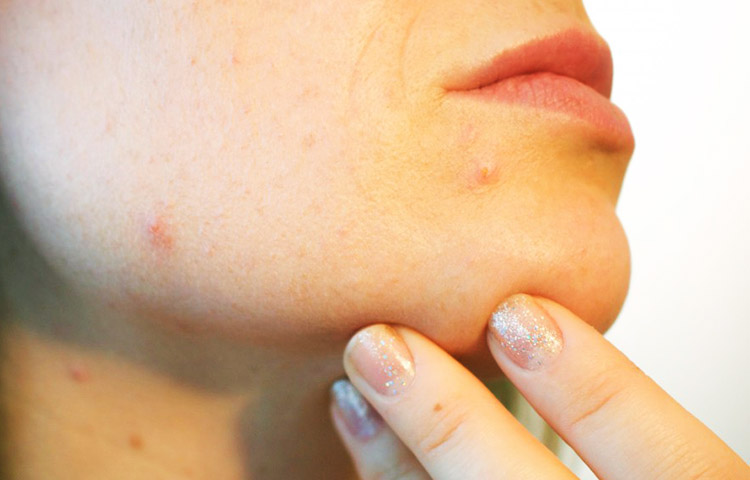 Diferencias entre acne y herpes