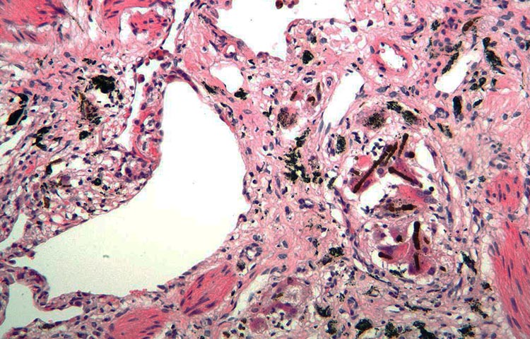 Diferencias entre mesotelioma y asbestosis