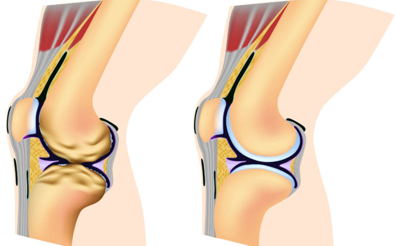 Diferencias entre osteoartritis y artritis