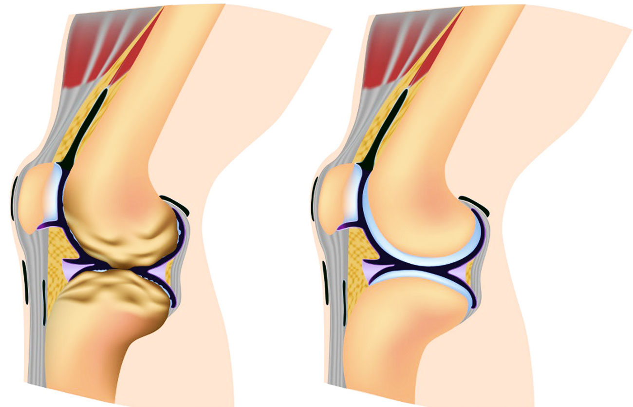 Болит колено при сгибании и разгибании. Ревматоидный артрит колена. Ревматоидный артрит и здоровый сустав. Ювенильный ревматоидный артрит коленного сустава. Ревматоидный артрит на коленке.