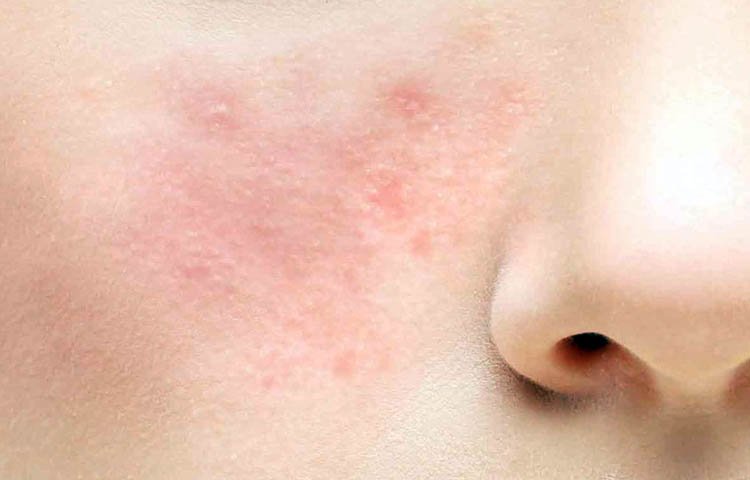 causas y sintomas de la rosacea