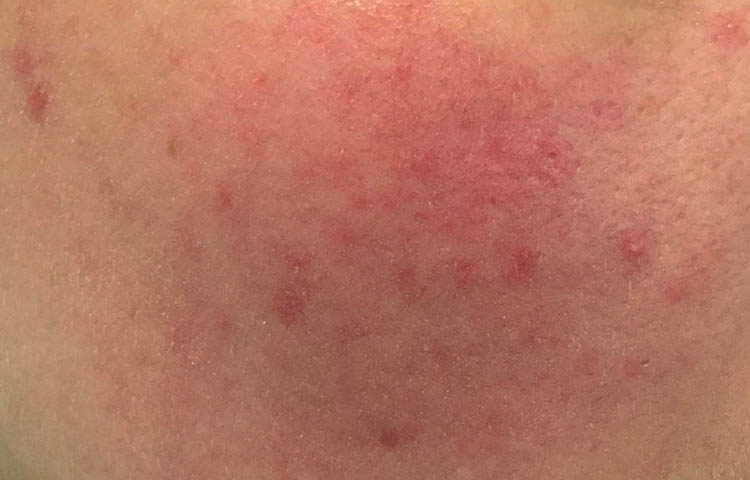 diagnostico de la rosacea