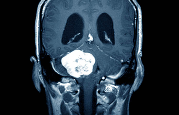 sintomas del neurinoma del acustico