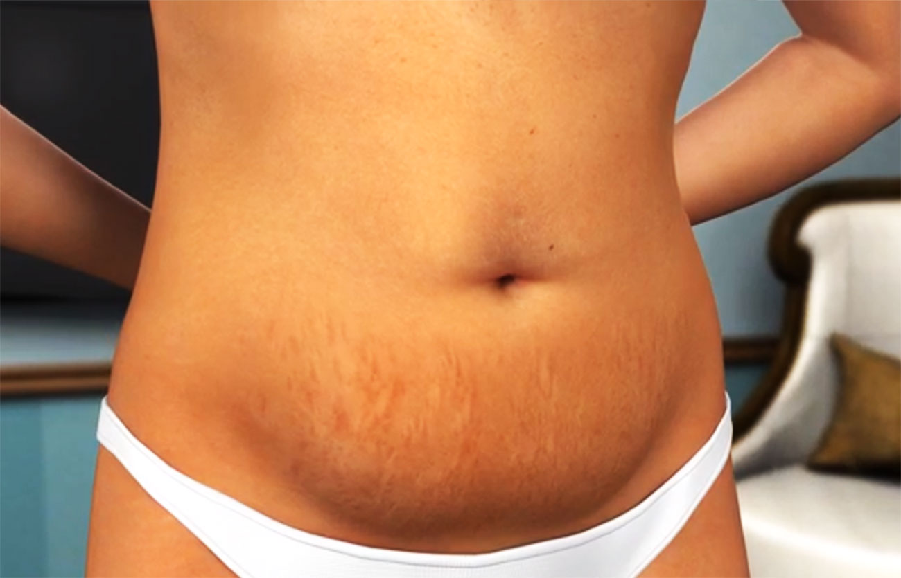 Diferencias entre abdominoplastia y liposucción