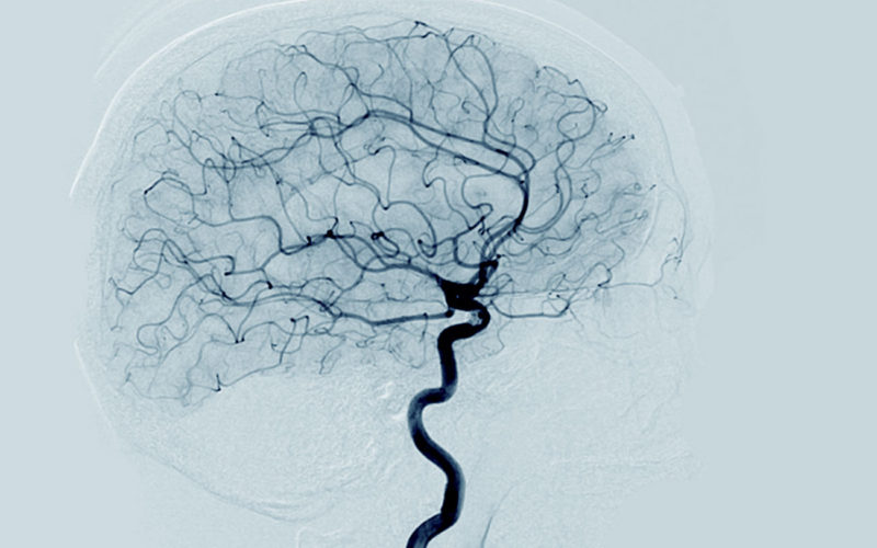 Diferencias entre angiografía y angioplastia