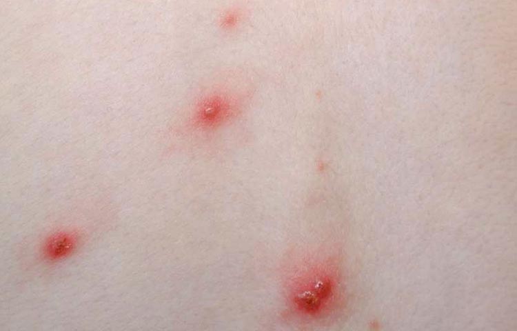 Diferencias entre el sarampión y la varicela