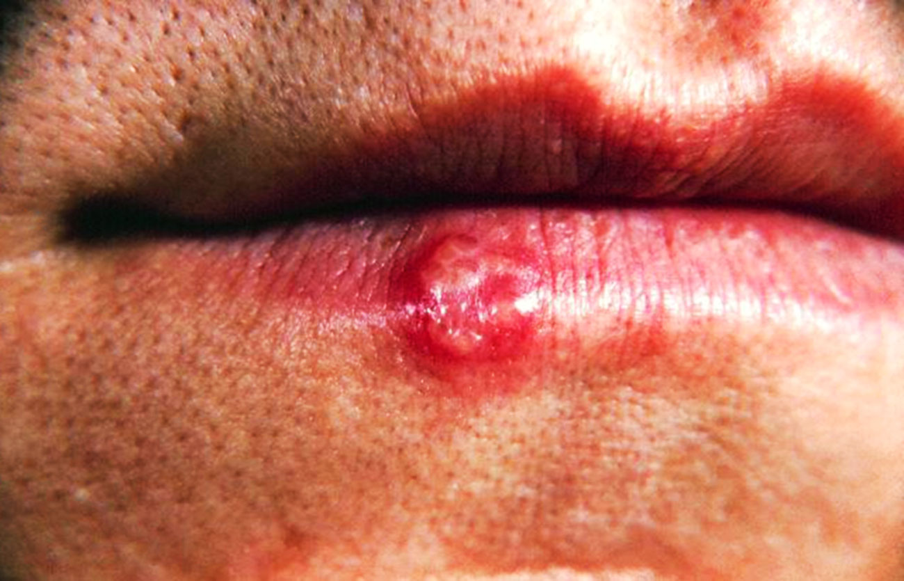 Diferencias entre herpes y verrugas
