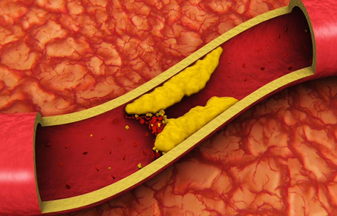Diferencias entre el colesterol sanguíneo y el colesterol dietético