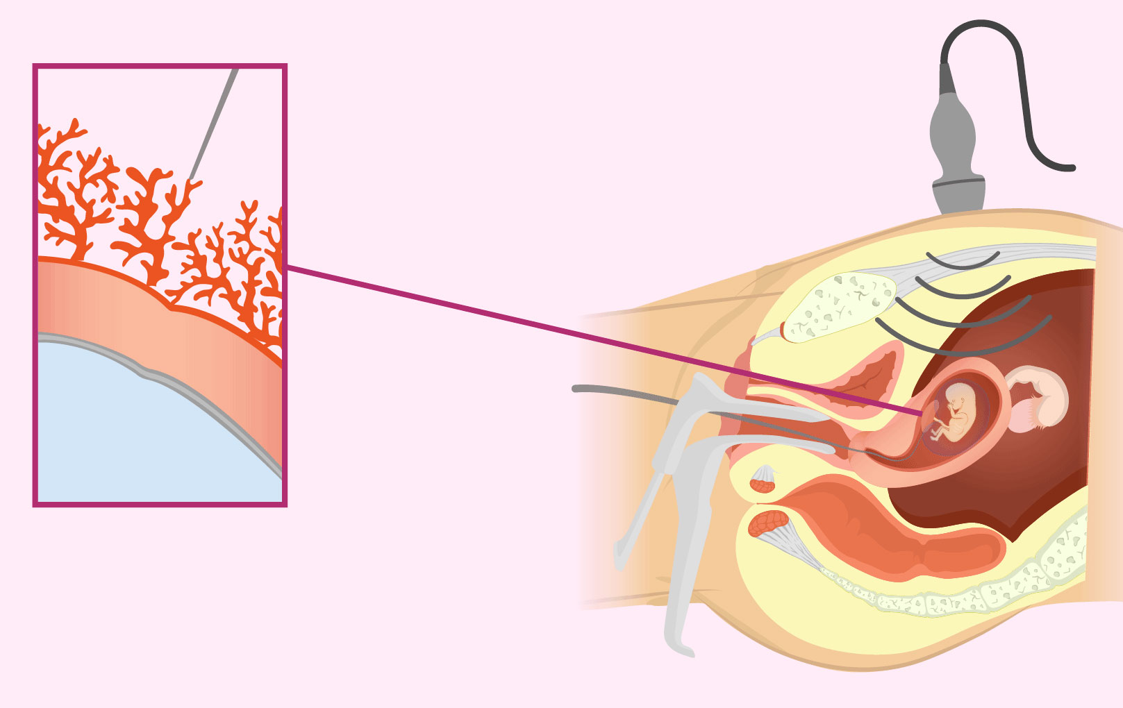 Diferencias entre muestra de vellosidades coriónicas y amniocentesis