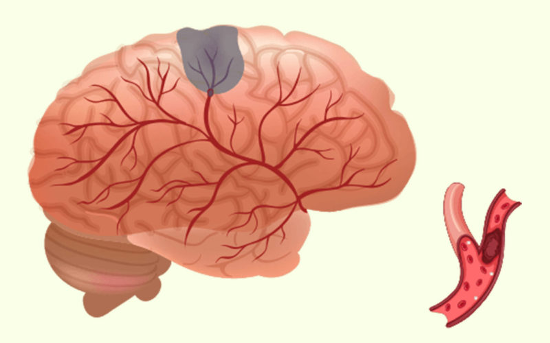 Diferencias entre accidente cerebrovascular hemorrágico e isquémico