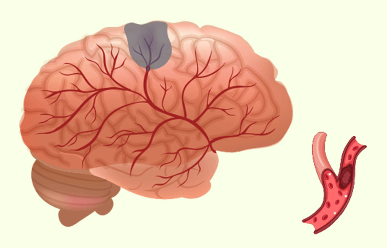 Diferencias entre accidente cerebrovascular hemorrágico e isquémico