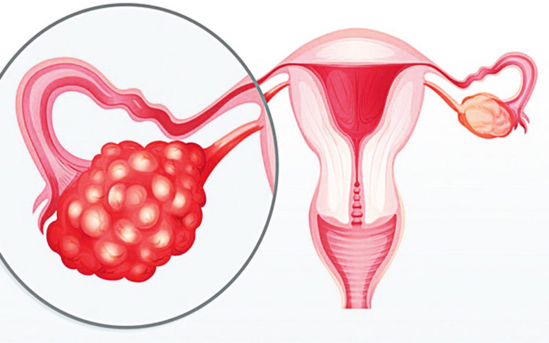 Diferencias entre el cáncer de ovario y los quistes ováricos