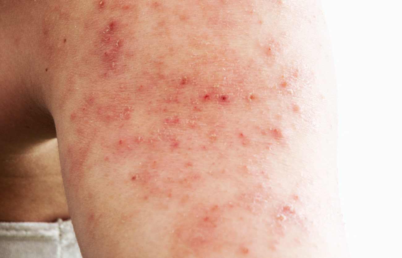 Diferencias entre el eccema y la dermatitis atópica