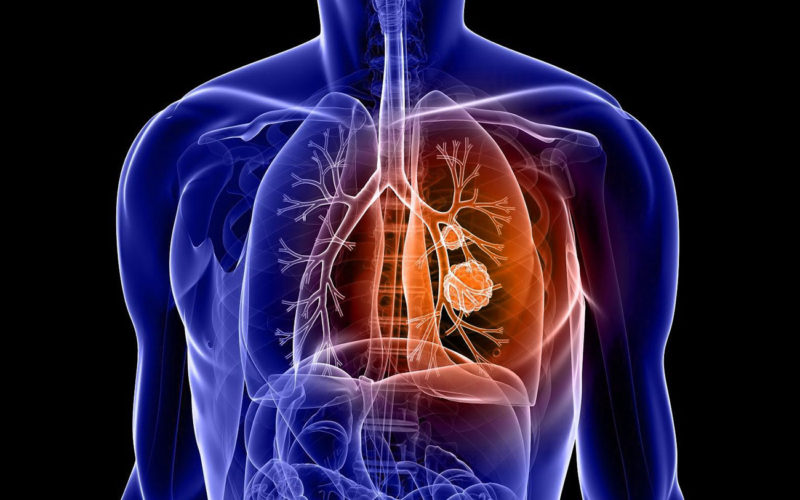 Diferencias entre enfisema y empiema