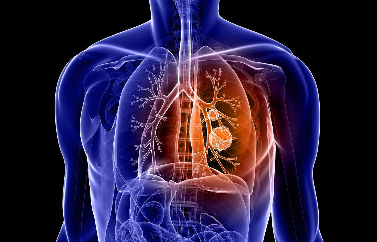 Diferencias entre enfisema y empiema