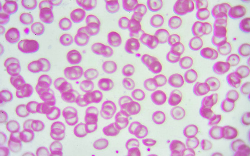 Diferencias entre la beta talasemia y la alfa talasemia