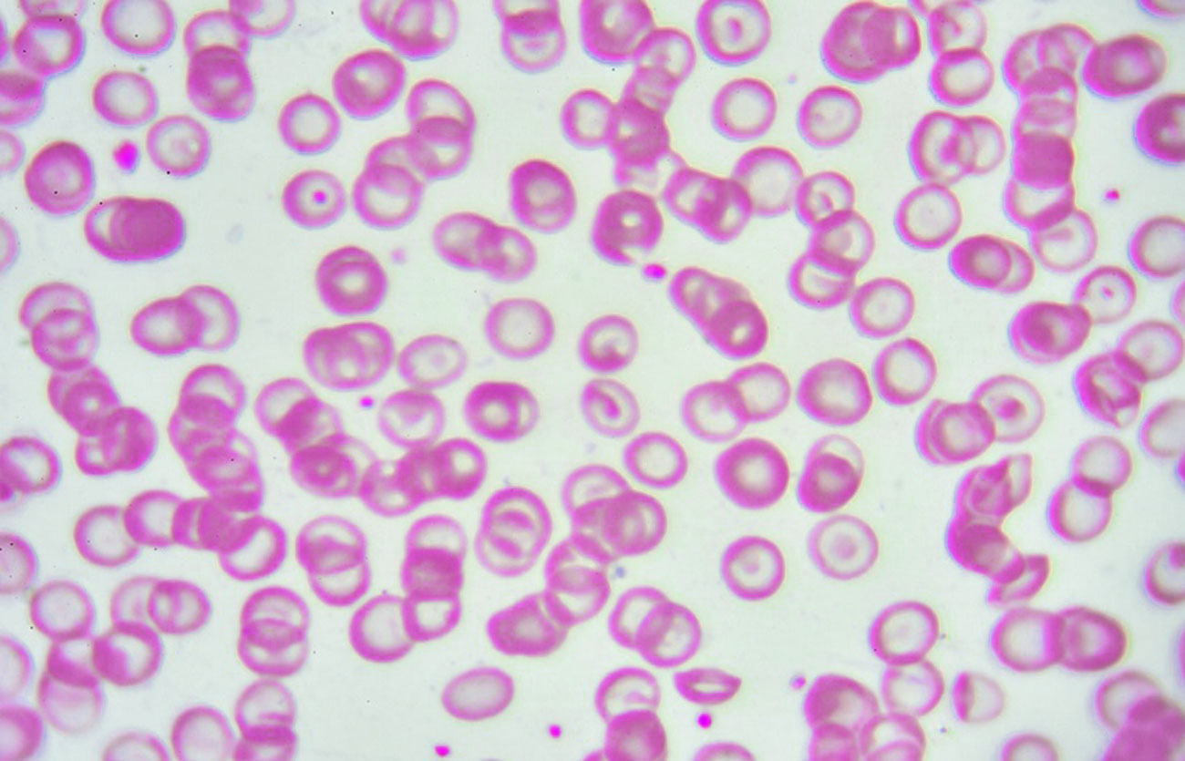 Diferencias entre la beta talasemia y la alfa talasemia