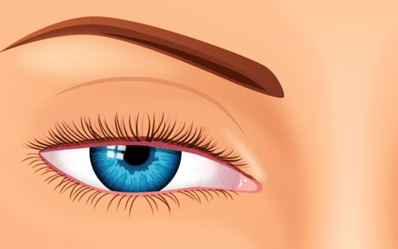 Diferencias entre la blefaroplastia y la ptosis