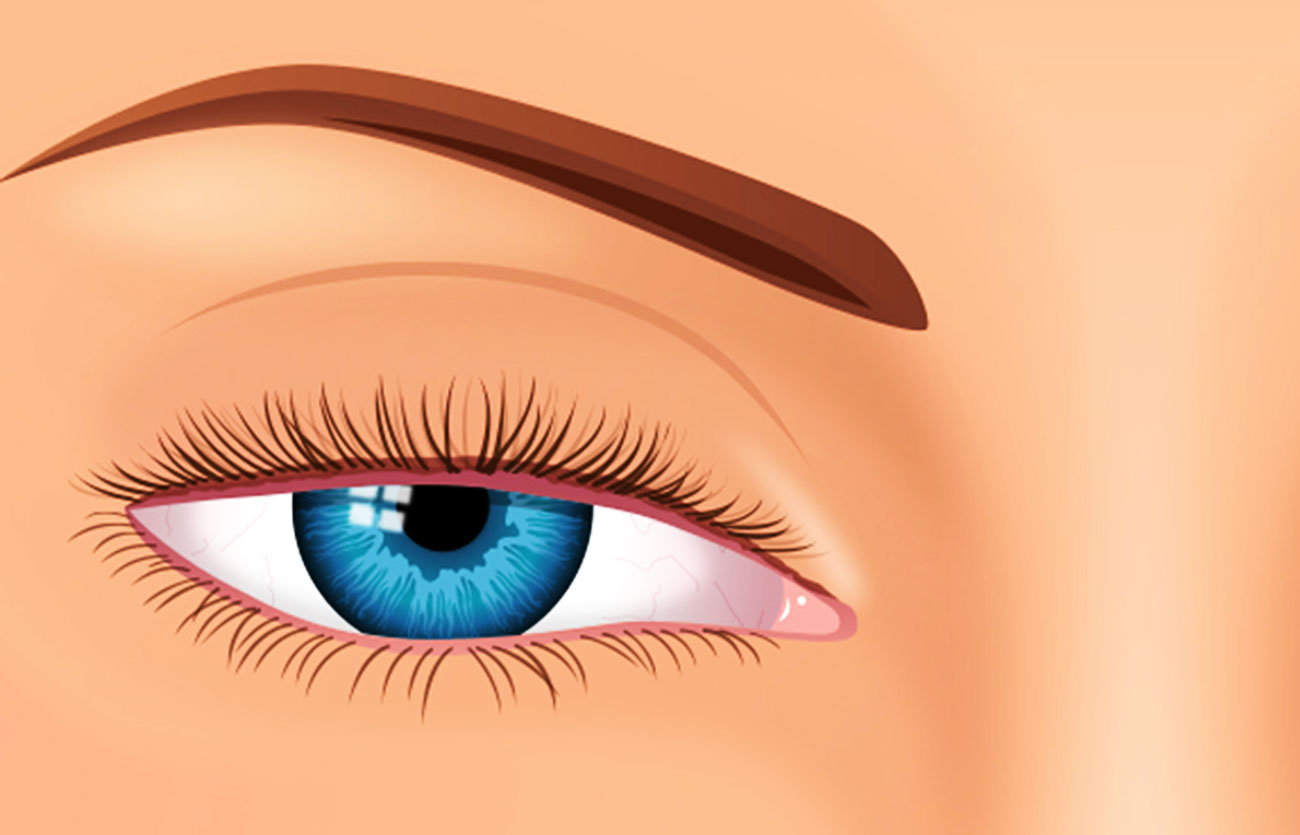 Diferencias entre la blefaroplastia y la ptosis