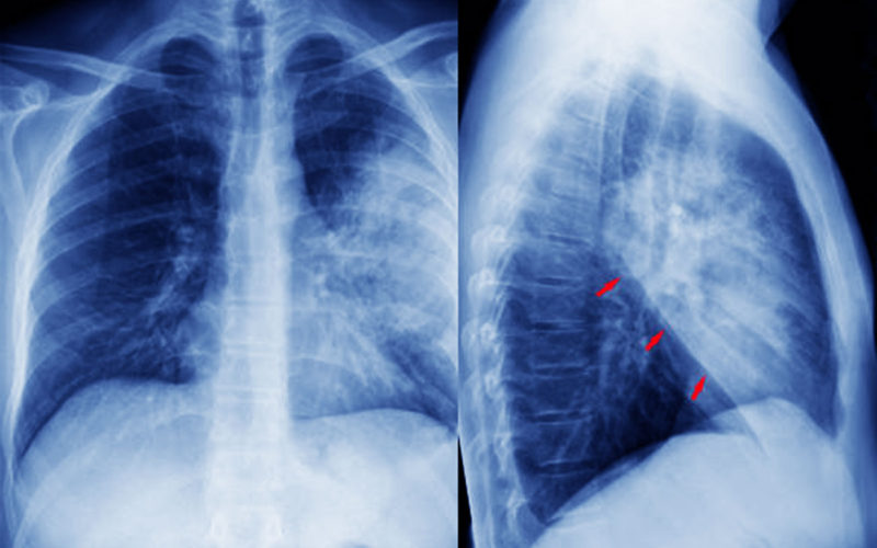 Diferencias entre la bronconeumonía y la neumonía lobar