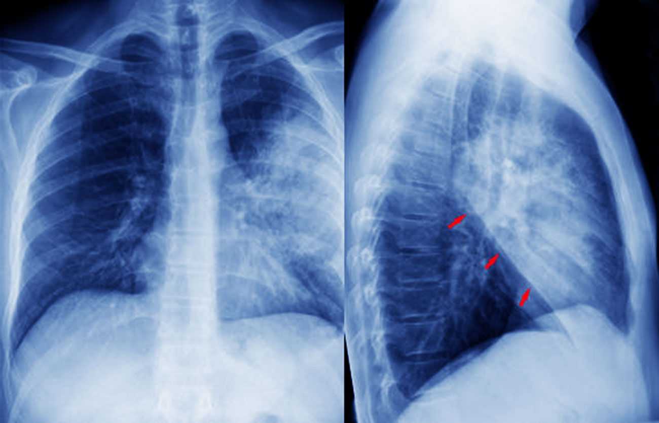 Diferencias entre la bronconeumonía y la neumonía lobar