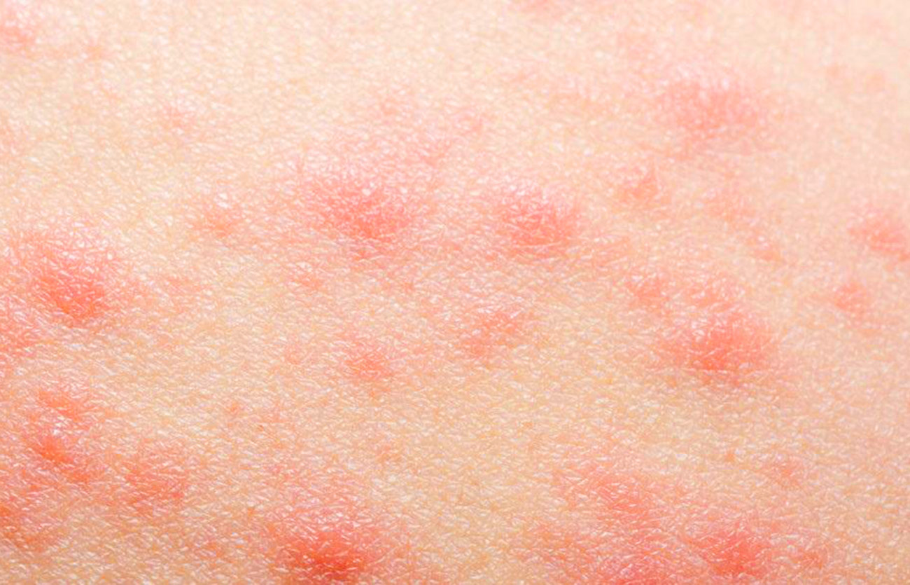 Diferencias entre la dermatitis de contacto y la dermatitis atópica