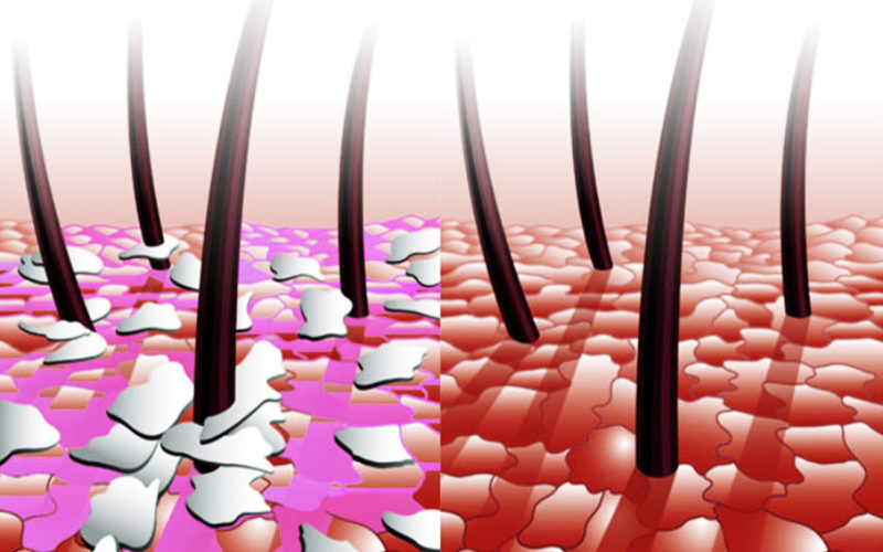 Diferencias entre la dermatitis seborreica y la psoriasis