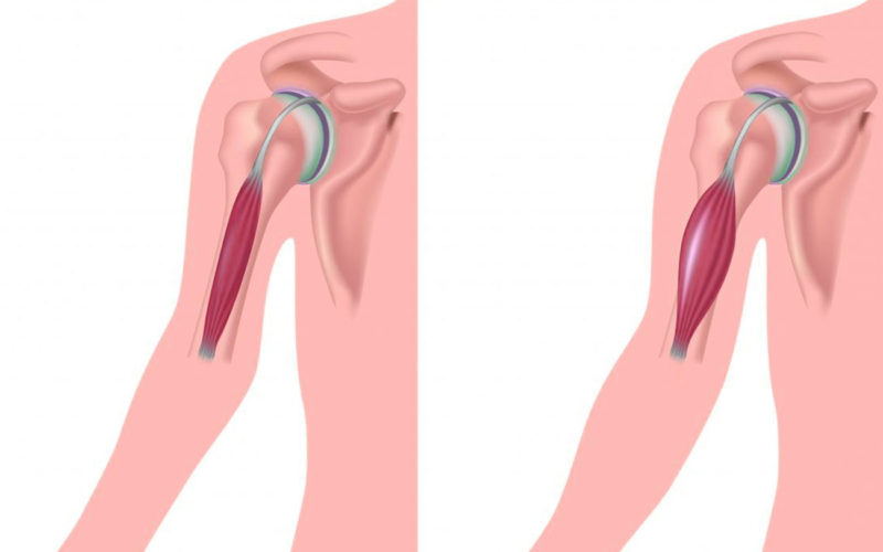 Diferencias entre la distrofia muscular de Becker y de Duchenne