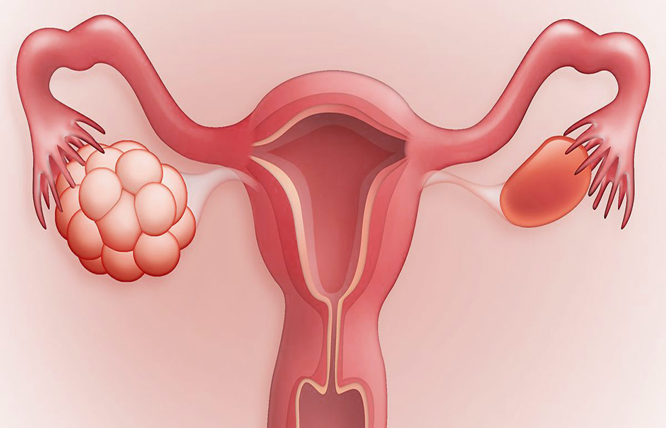 Diferencias entre la endometriosis y el SOP