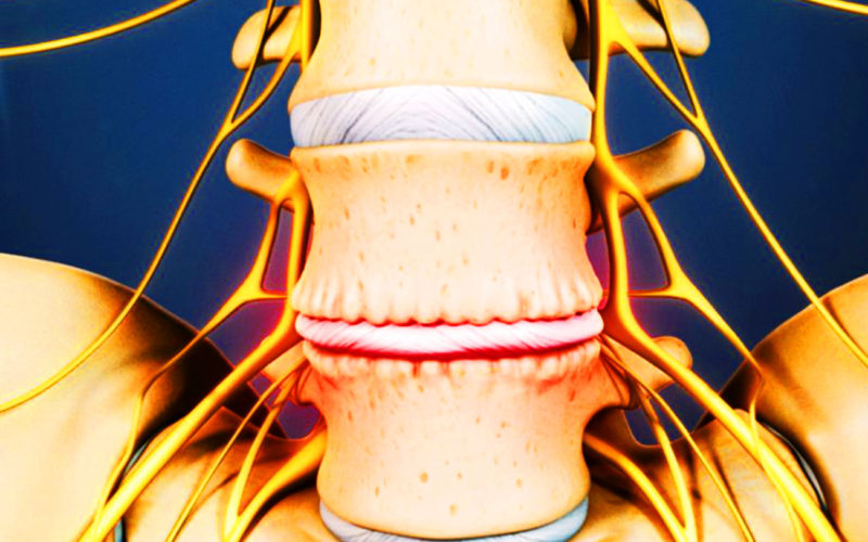 Diferencias entre la enfermedad degenerativa del disco y la espondilitis anquilosante