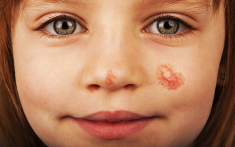 Diferencias entre la hemangioma y la angioma