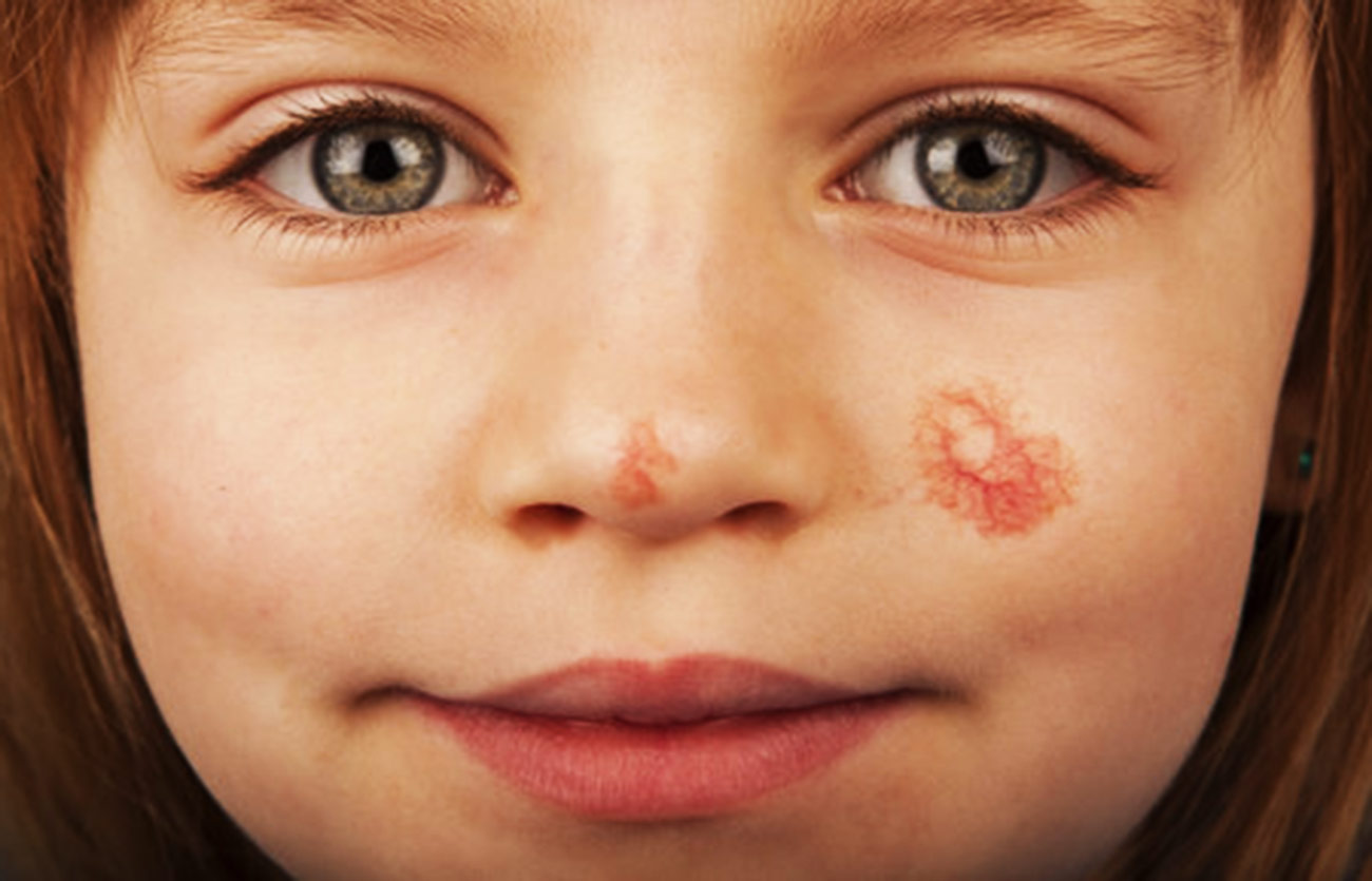 Diferencias entre la hemangioma y la angioma