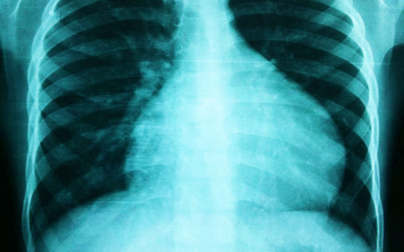 Diferencias entre la pericarditis y la miocarditis