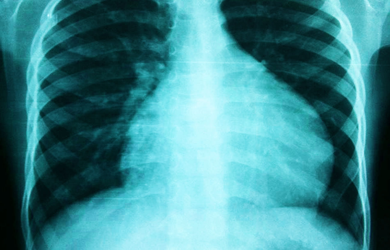 Diferencias entre la pericarditis y la miocarditis