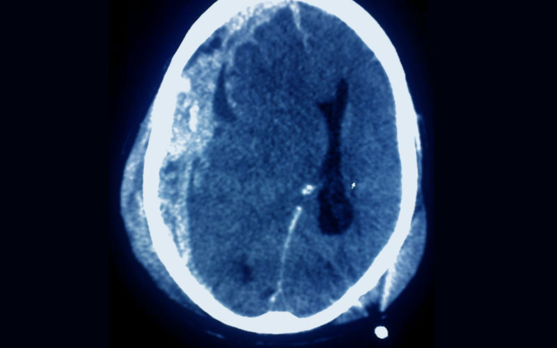 Diferencias entre la subdural y la epidural