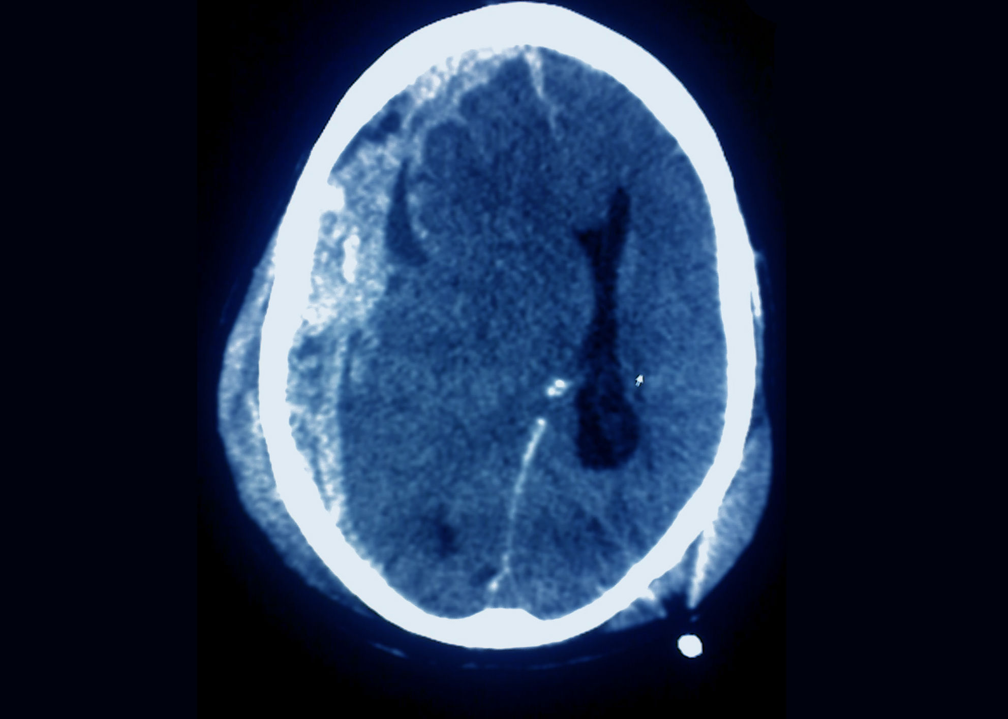 Diferencias entre la subdural y la epidural