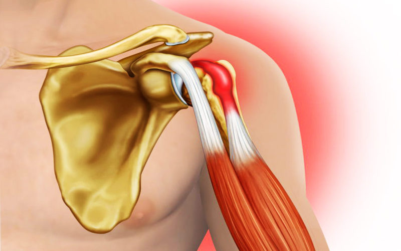 Diferencias entre la tendinitis y la artritis