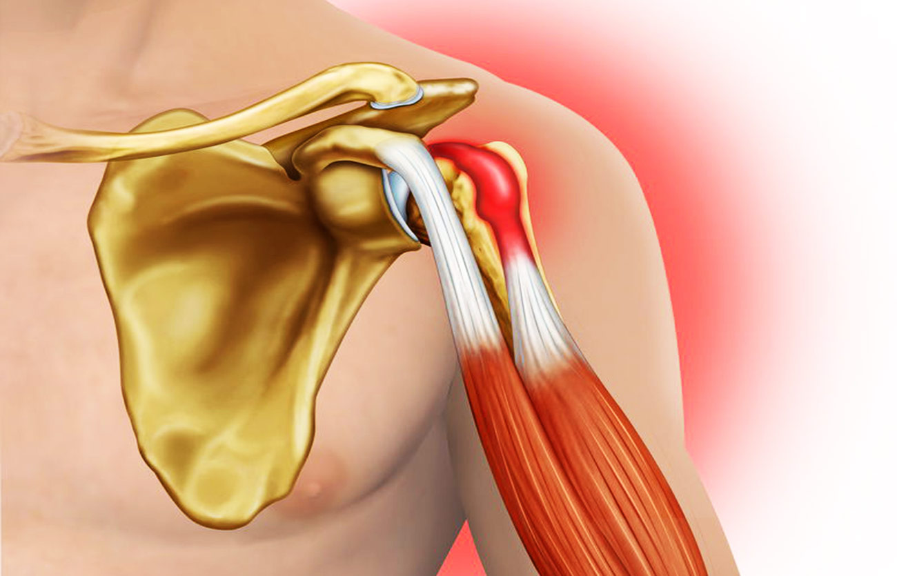 Операция разрыва сухожилия надостной мышцы. Сухожилия плеча. Тендинит длинной головки бицепса плеча. Разрыв сухожилия плечевого сустава. Тенодез длинной головки.