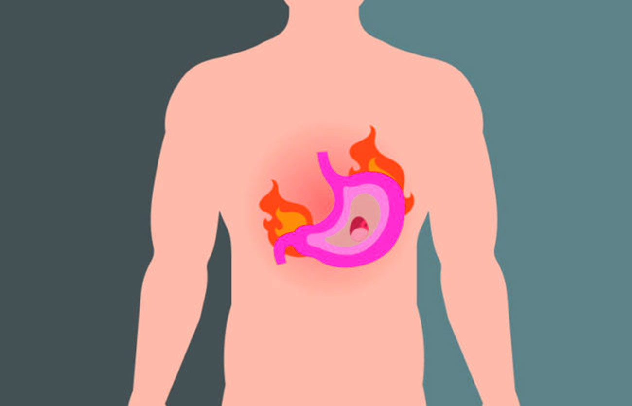 Diferencias entre la úlcera duodenal y la gastritis