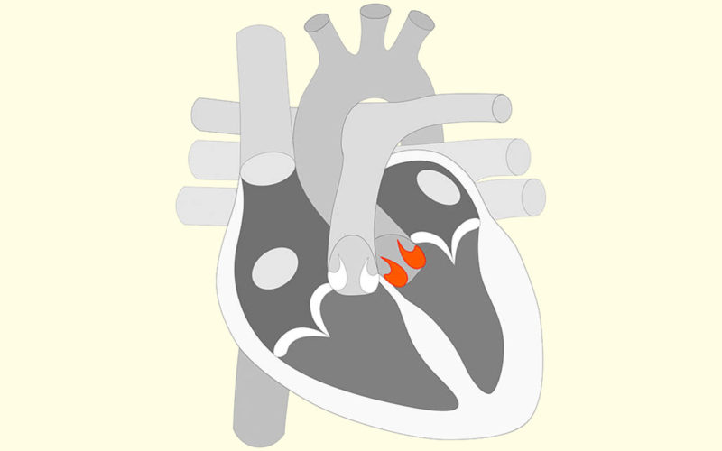 Diferencias entre la válvula mitral y la válvula aórtica