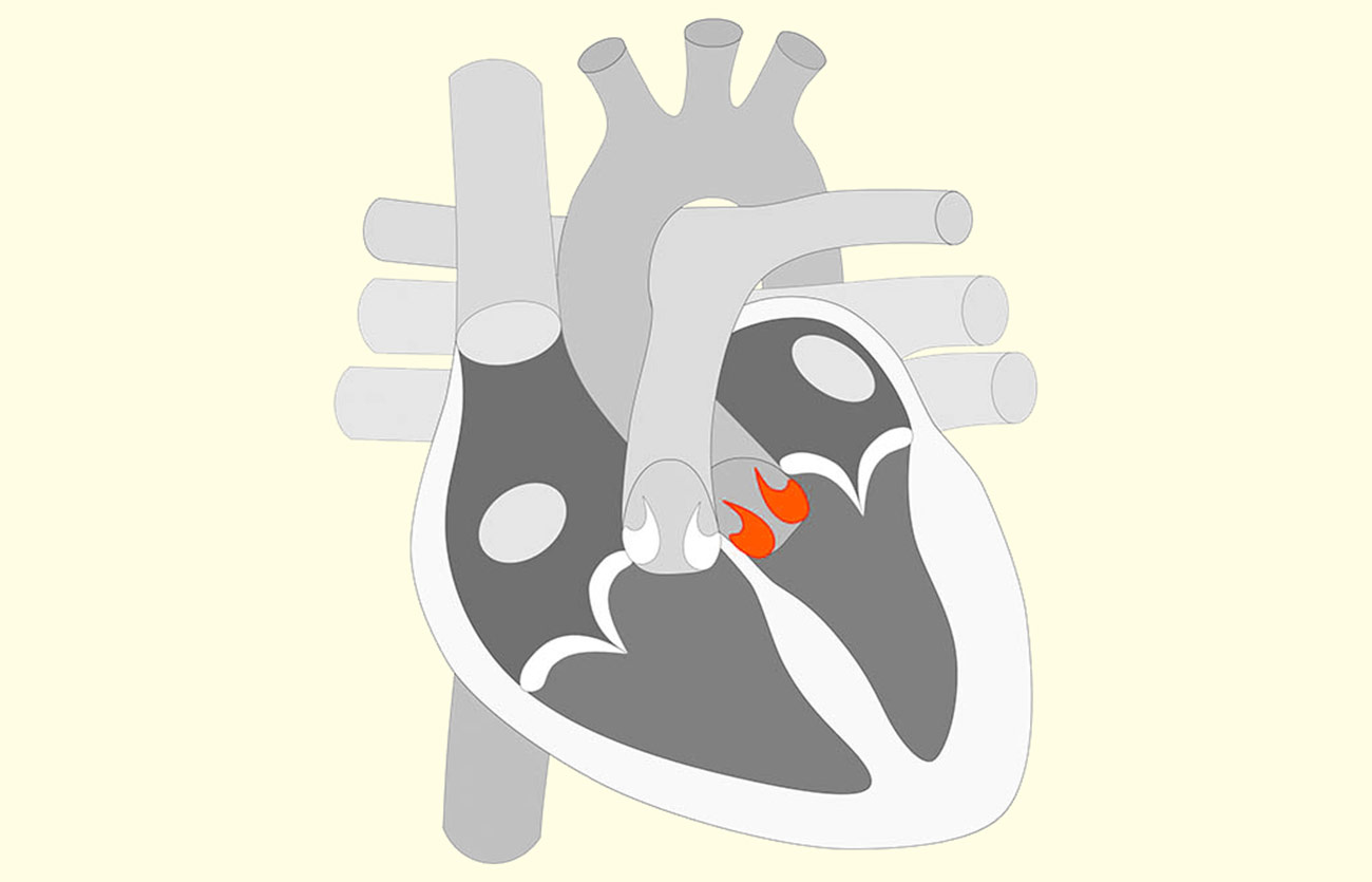 Diferencias entre la válvula mitral y la válvula aórtica