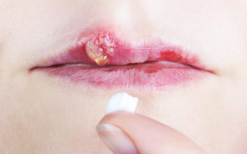 Diferencias entre las ampollas febriles y el herpes labial