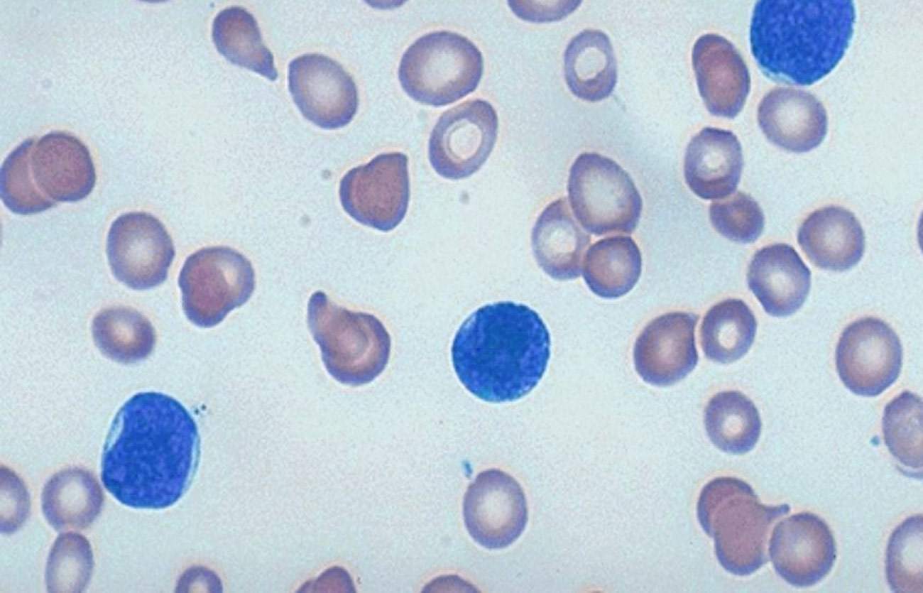 Diferencias entre los linfoblastos y los mieloblastos