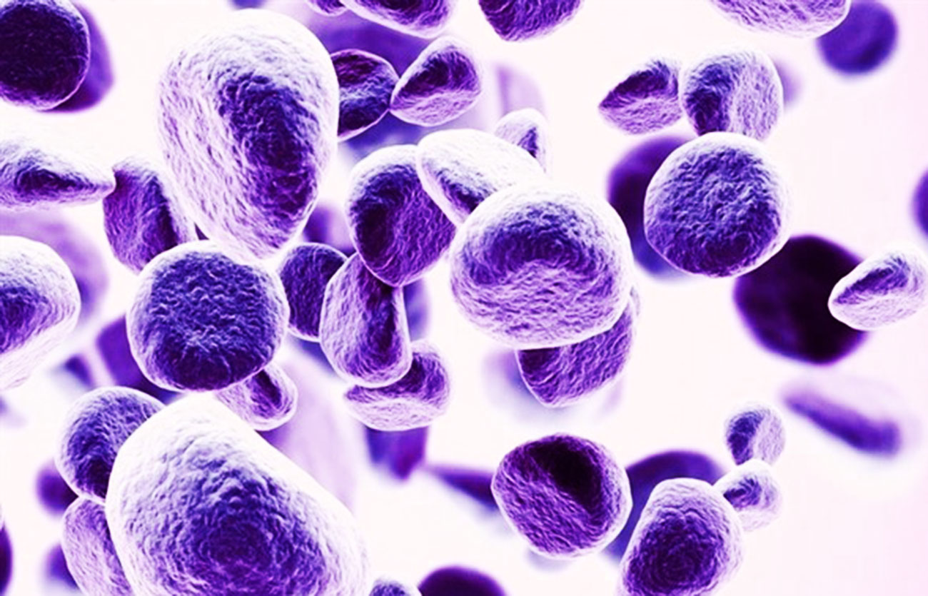 Diferencias entre síndrome mielodisplásico y trastorno mieloproliferativo